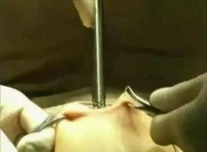 宫腔镜手术视频过程,从术前准备到术后恢复